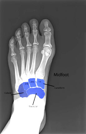 foot-broken